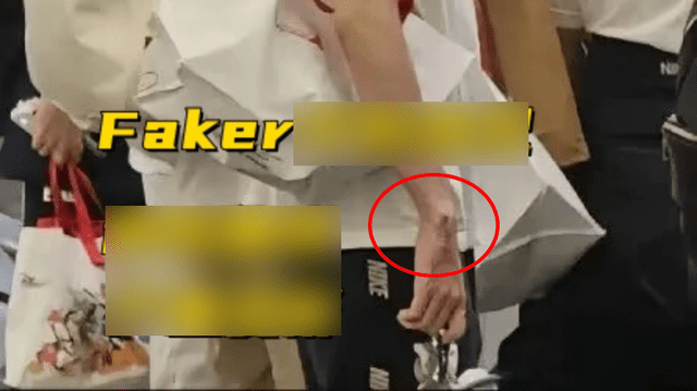 Faker's serious hand injury captured during the 2024 World Championship Faker's serious hand injury captured during the 2024 World Championship