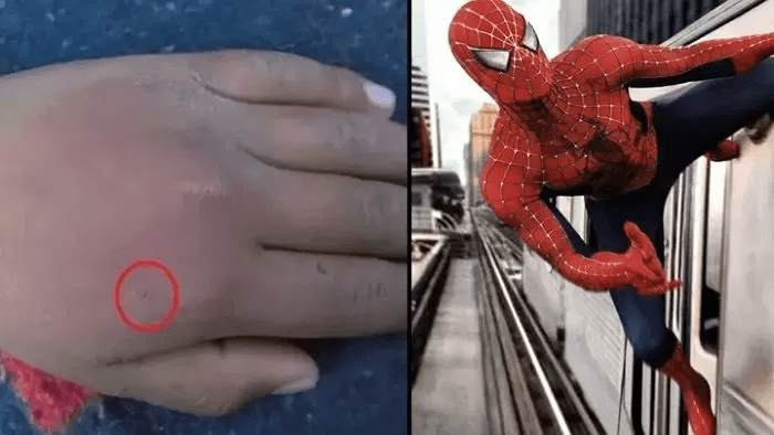Bitten by a spider with the hope of becoming Spider-Man, male gamer hospitalized urgently 1 A young gamer dreams of becoming Spider-Man