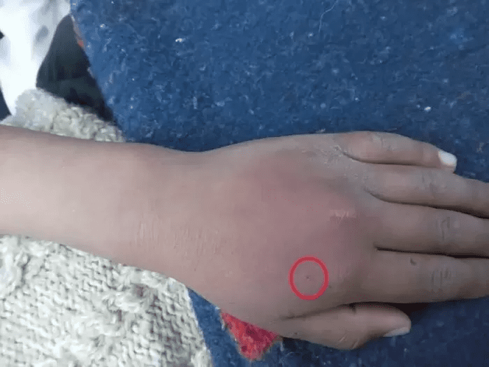 Bitten by a spider with the hope of becoming Spider-Man, male gamer hospitalized urgently 3 A young gamer dreams of becoming Spider-Man