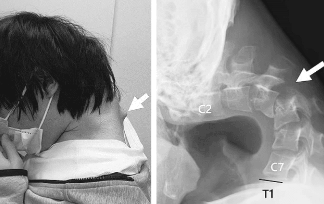 This case was published in JOS Case Reports with the patient's consent and family approval. Health risks associated with excessive gaming, Image 2.